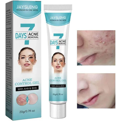 Crema tratamiento acne 7 days