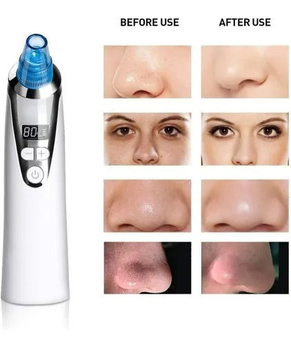 EXTRACTOR DE ESPINILLAS