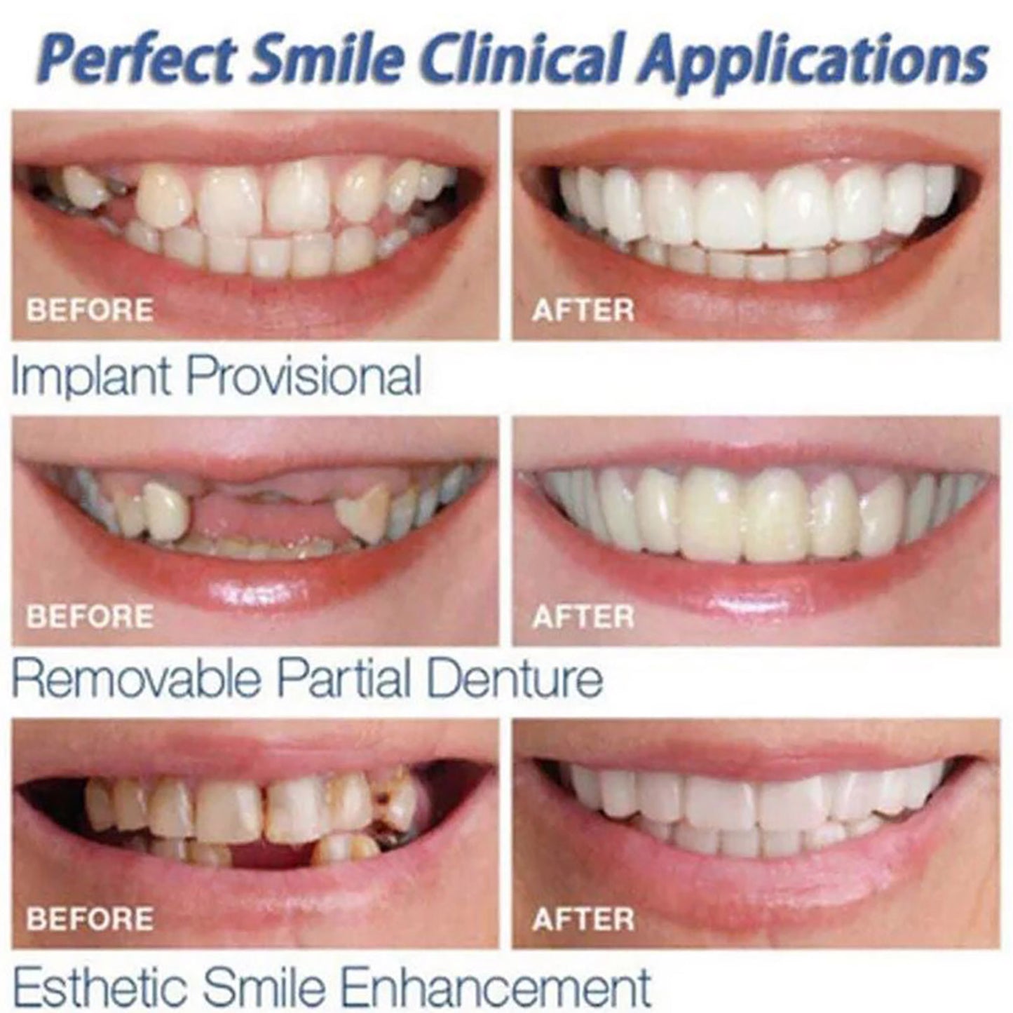 CARILLAS DENTALES ONSMILE D