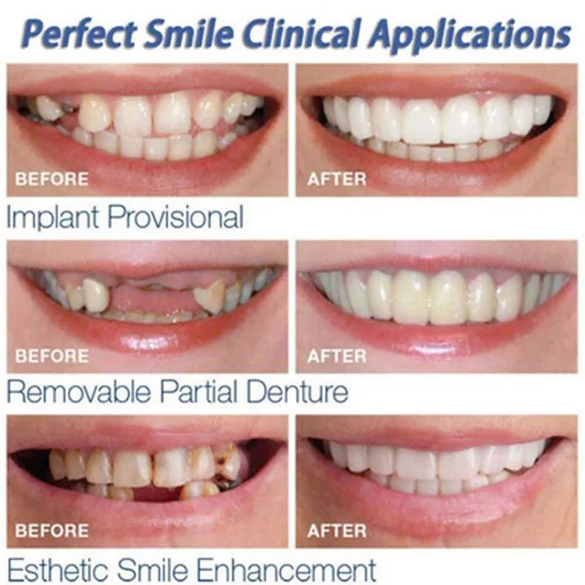 CARILLAS DENTALES ONSMILE D