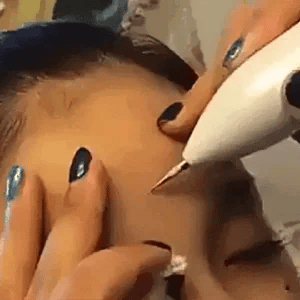 Cauterizado facial